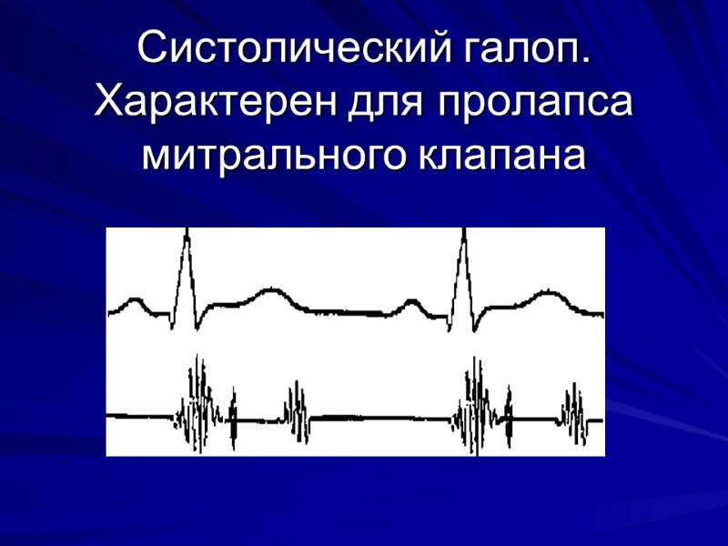 Систолический галоп. Характерен для пролапса митрального клапана Систолический галоп. Характерен для пролапса митрального клапана